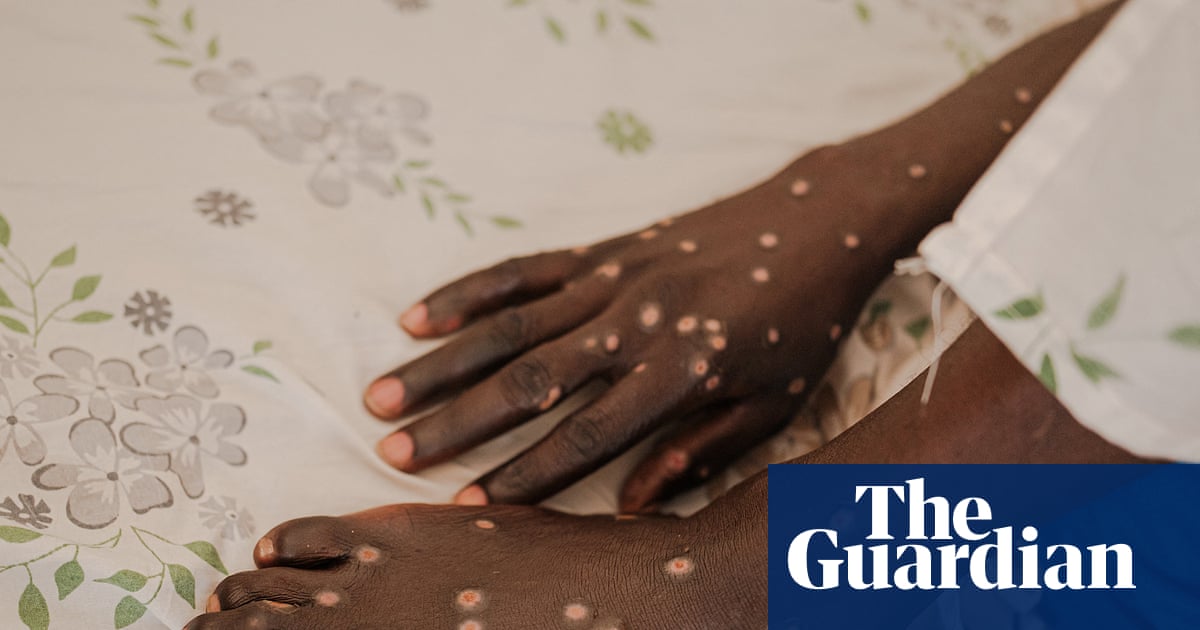Mpox Is Back, in New Countries, and Children Appear Worst Affected